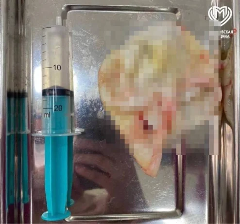 Врачи нашли гигантское паразитное новообразование у 17-летней москвички