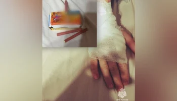 В Удмуртии мальчик получил ожог из-за взрыва петарды