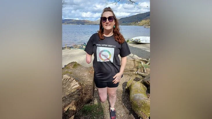 В Британии женщина лишилась руки после оставленной собакой царапины В Британии женщина лишилась руки после оставленной собакой царапины