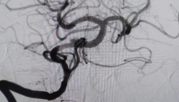 Врачи в Подмосковье спасли мужчину с редким &laquo;ночным&raquo; инсультом