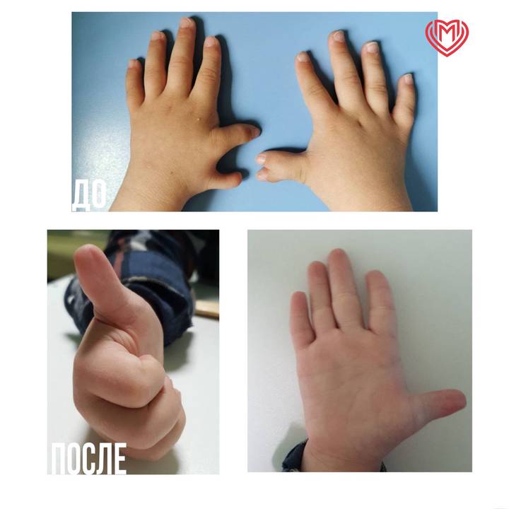 Мальчика с 12 пальцами на руках прооперировали в Московской больнице