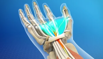 Болезни родом из офиса: такой коварный карпальный туннельный синдром