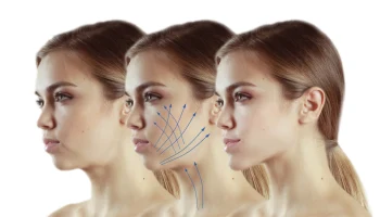 Ultraformer III: революционный SMAS-лифтинг нового поколения