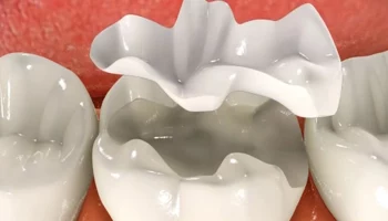 Керамические накладки: Инновации в современной стоматологии