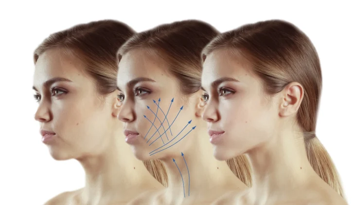 Ultraformer III: революционный SMAS-лифтинг нового поколения