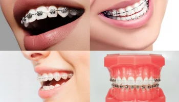 Виды брекетов: причины хруста челюсти и бруксизм