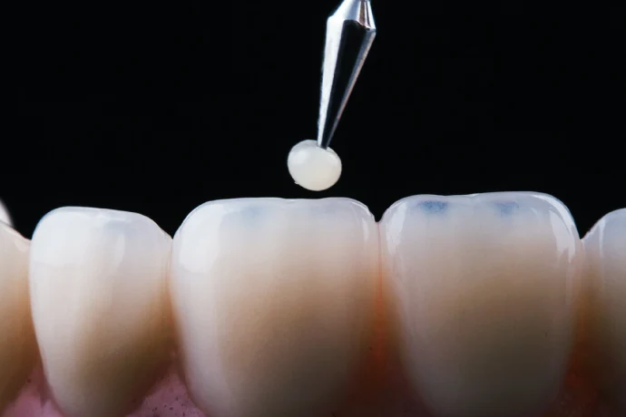 Наращивание зубов: современные методы и стоимость восстановления улыбки